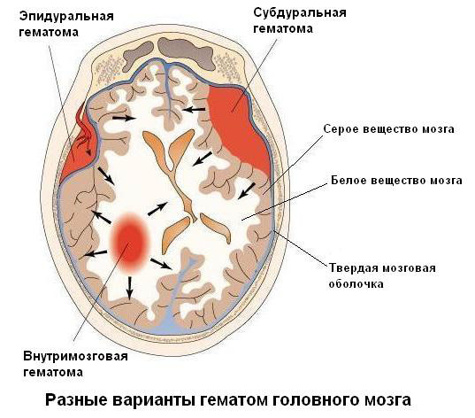 Типичное положение «лягушечьих лап» Поперечное сдавливание таза за гребни подвздошных костей - student2.ru