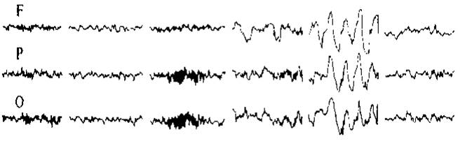 Електроенцефалограма - student2.ru