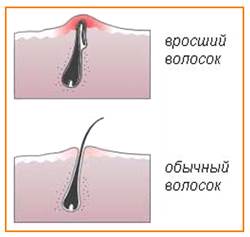 Как избежать врастания волос? - student2.ru