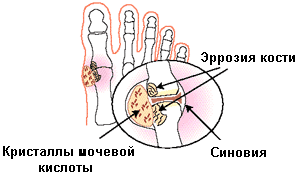 Нарушение обмена пуриновых и пиримидиновых оснований - student2.ru