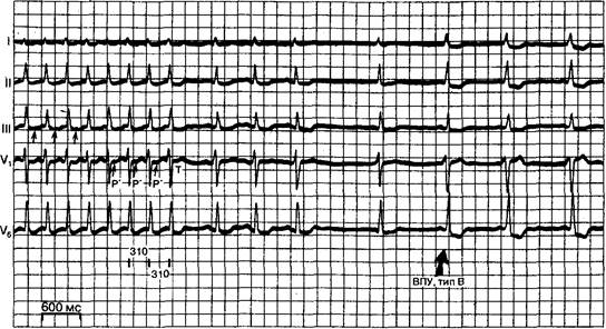 Циркуляторная тахикардия с вовлечением дополнительного пути - student2.ru