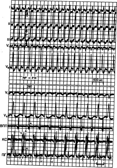 Циркуляторная тахикардия с вовлечением дополнительного пути - student2.ru