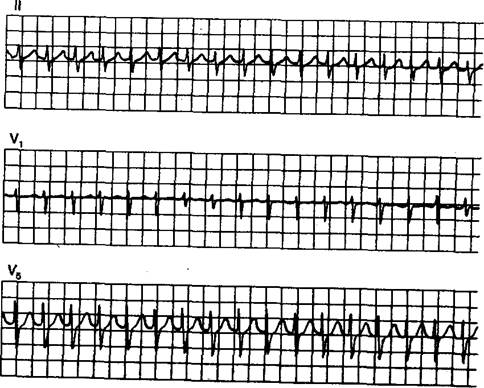 ГЛАВА 10. Пароксизмальная наджелудочковая тахикардия - student2.ru