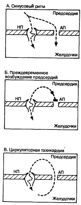 ГЛАВА 10. Пароксизмальная наджелудочковая тахикардия - student2.ru