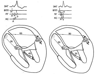 Электрокардиография у больных с синдромом ВПУ - student2.ru