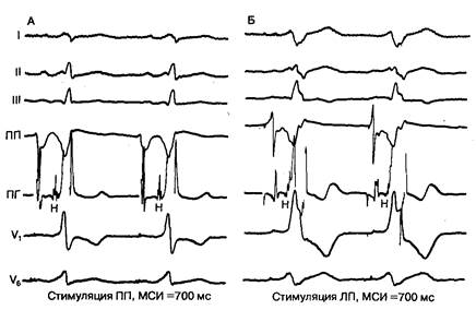 Электрокардиография у больных с синдромом ВПУ - student2.ru