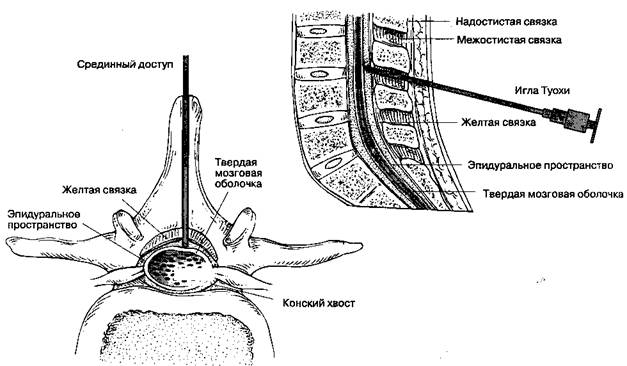 А. Идентификация эпидурального пространства - student2.ru