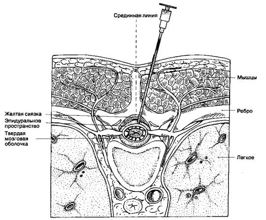 А. Идентификация эпидурального пространства - student2.ru