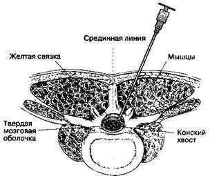 Длительная спинномозговая анестезия - student2.ru