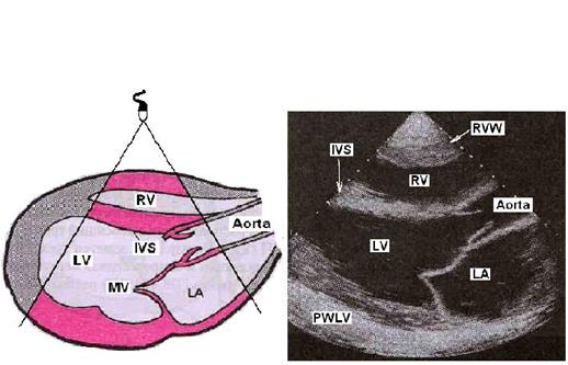 Допплеровская эхокардиография - student2.ru
