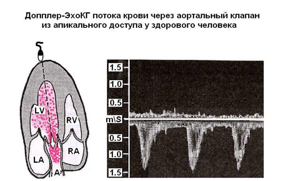 Допплеровская эхокардиография - student2.ru