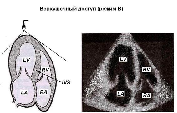 Допплеровская эхокардиография - student2.ru