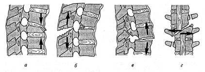 Неосложненные повреждения тел позвонков - student2.ru