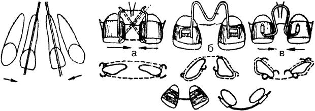 Несъемные ортодонтические аппараты - student2.ru