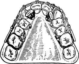Несъемные ортодонтические аппараты - student2.ru