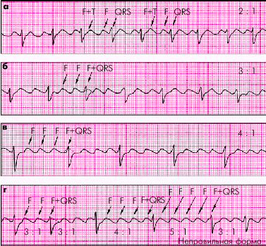 Предсердная пароксизмальная тахикардия - student2.ru