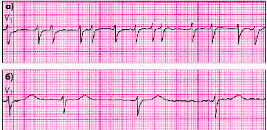 Предсердная пароксизмальная тахикардия - student2.ru