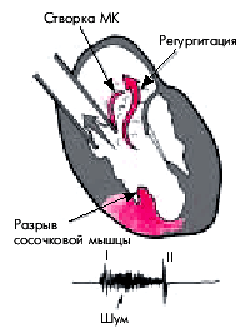 Разрыв межжелудочковой перегородки - student2.ru