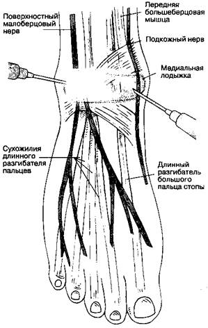 Регионарная анестезия стопы - student2.ru