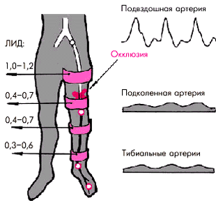 Ультразвуковая допплерография артерий нижних конечностей - student2.ru