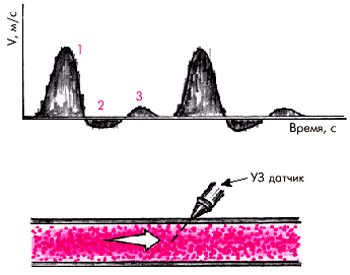 Ультразвуковая допплерография артерий нижних конечностей - student2.ru