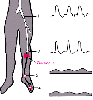 Ультразвуковая допплерография артерий нижних конечностей - student2.ru