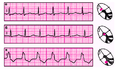 Ускоренные эктопические ритмы (непароксизмальная тахикардия) - student2.ru