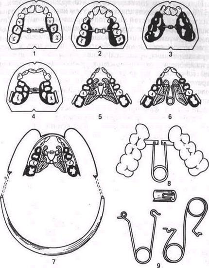 В периоде постоянного прикуса используют следующие механически-действующие ортодонтические аппараты в зави- - student2.ru
