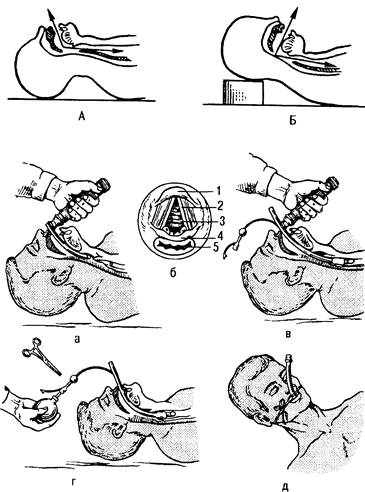 восстановление проходимости дыхательных путей - student2.ru