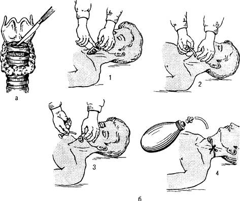 восстановление проходимости дыхательных путей - student2.ru