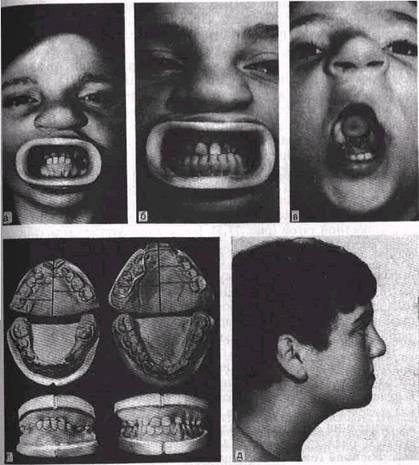 Врожденная расщелина в челюстно-лицевой области - student2.ru