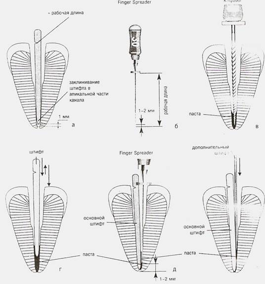 Введение в корневой канал эндогерметика - student2.ru