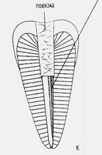 Введение в корневой канал эндогерметика - student2.ru