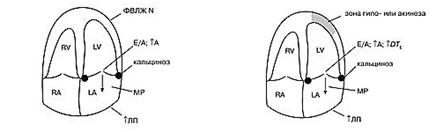 эхокардиографические изменения у больных с ибс - student2.ru