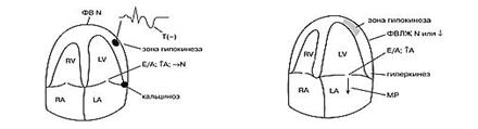 эхокардиографические изменения у больных с ибс - student2.ru