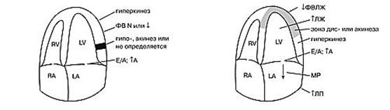 эхокардиографические изменения у больных с ибс - student2.ru