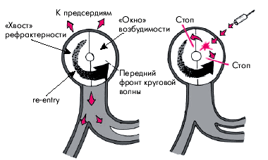 Электрокардиостимуляция - student2.ru