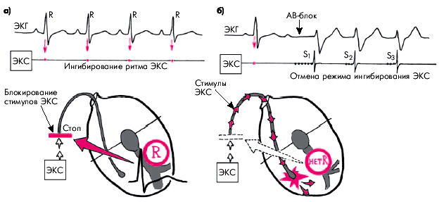 Электрокардиостимуляция - student2.ru