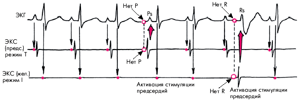 Электрокардиостимуляция - student2.ru