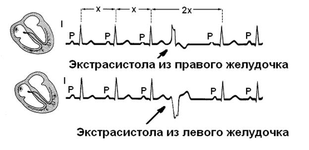 Этап. Анализ зубцов, сегмента ST и вольтажа - student2.ru