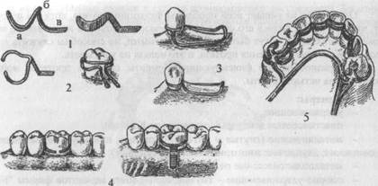 фиксация протезов в полости рта - student2.ru