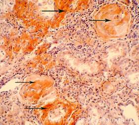 Амилоидоз почек - student2.ru