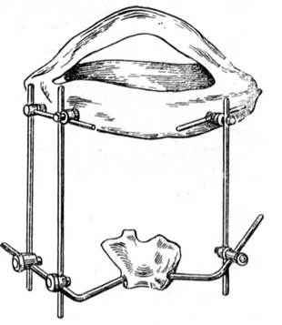 Аппараты и приспособления для фиксации и репозиции отломков челюстей при переломах. - student2.ru