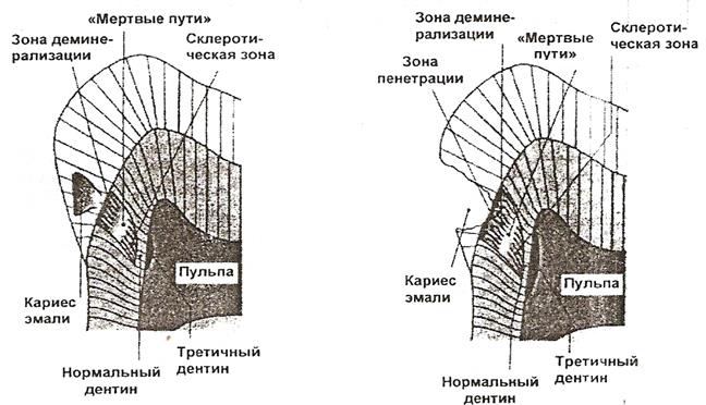 Перечисленные выше кариесогенные факторы и факторы резистентность действуют не только в детском возрасте, но и у взрослых - student2.ru