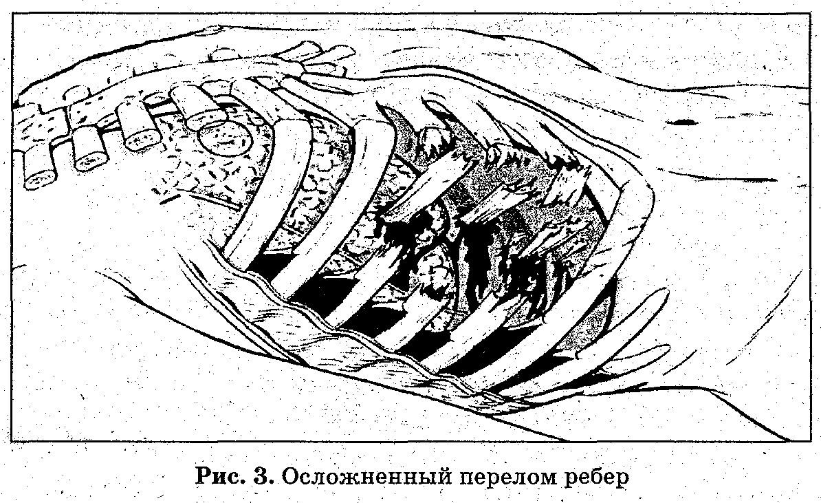 Проникающее ранение грудной клетки. - student2.ru