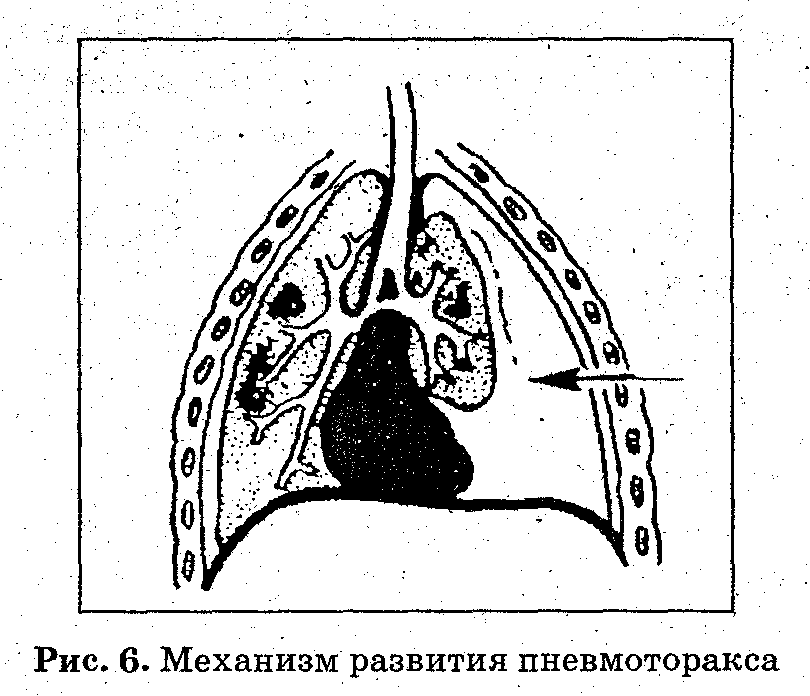 Проникающее ранение грудной клетки. - student2.ru