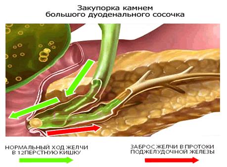 Созылмалы панкреатит» клиникалық жағдай бойынша - student2.ru