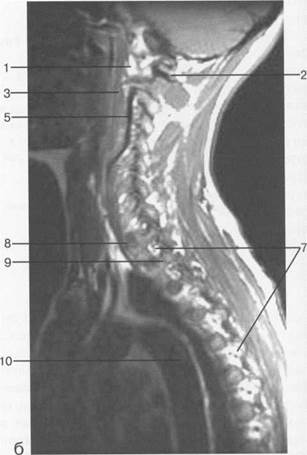 лучевая анатомия позвоночника и спинного мозга - student2.ru