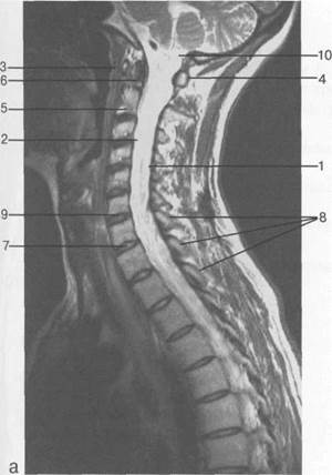 лучевая анатомия позвоночника и спинного мозга - student2.ru