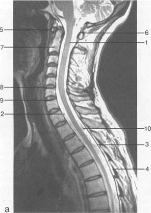 лучевая анатомия позвоночника и спинного мозга - student2.ru